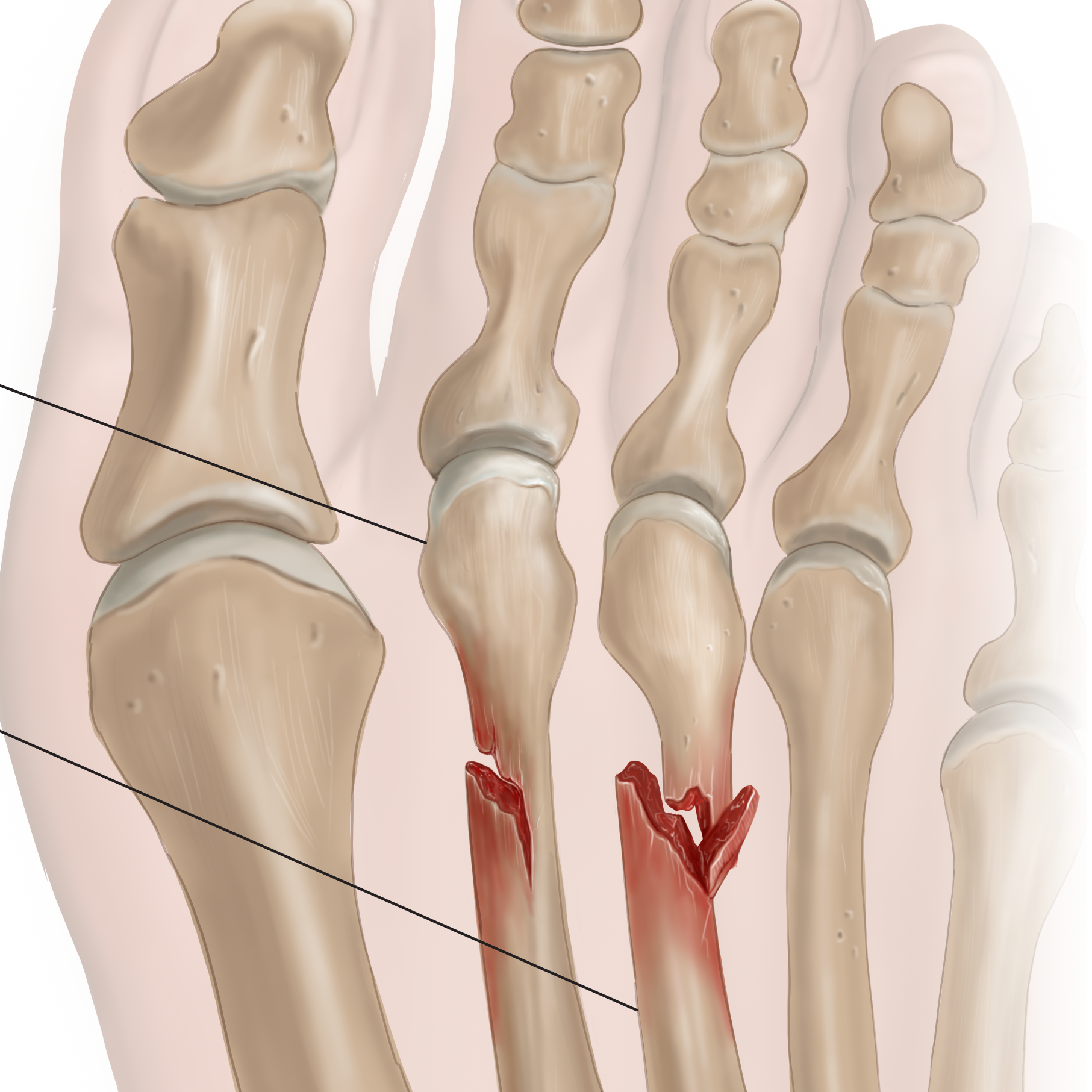 Med legal metatarsal fractures